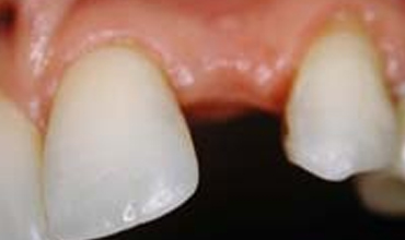 missing tooth