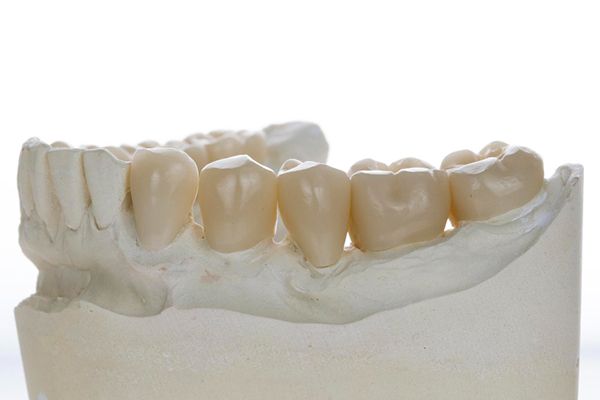 A woman showing her teeth in a smile, with hidden lingual braces not visible in the image.