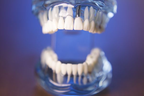 3d model of a jaw with a single tooth implant