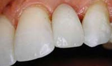 tooth fitted with a "Maryland Bridge"