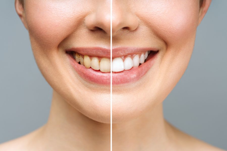 Woman teeth before and after whitening over white background dental clinic patient image symbolizes