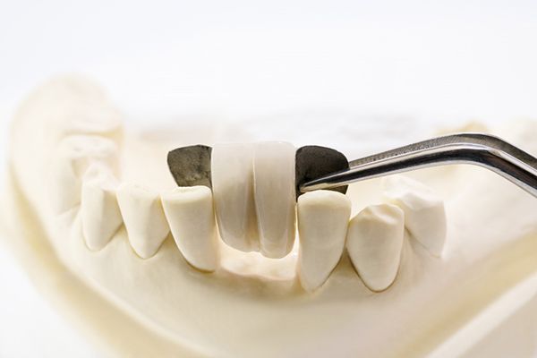 A woman with a cheerful smile, featuring clear braces that enhance her dental aesthetics.