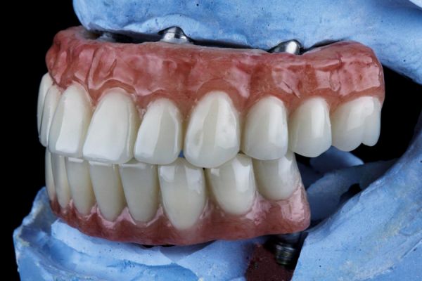 3d image of a jaw showing full arch dental implants