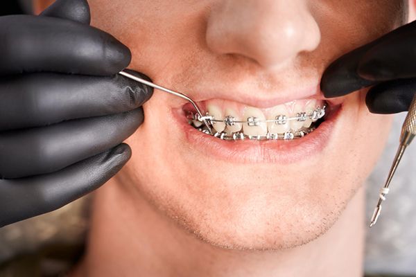 A man wearing metal braces, highlighting his dental treatment.