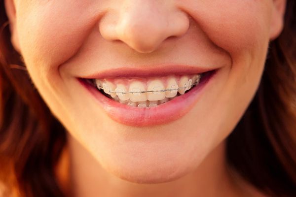A woman with a cheerful smile, featuring clear braces that enhance her dental aesthetics.